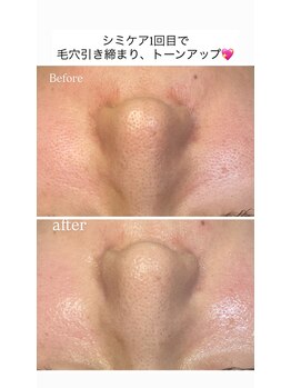 ココ(COCO)/シミケア、ビフォー、アフター