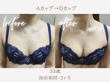 ハリスタ 六本木院(HARISTA)/3ヶ月間でBカップ→Dカップ