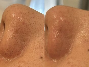 ビューティービレッジ(Beauty village)/超音波毛穴洗浄