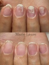 マリーロール 淀屋橋本店(Marie Laure)/自爪育成/深爪矯正/ネイルケア