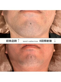 トゥルー(true)/ヒゲ脱毛　経過写真
