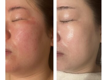 アドビューティ(Add Beauty)/≪プラズマフェイシャル≫