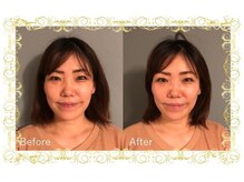 レメディ/美容鍼コース