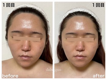 ダルセーニョ/コルギで「圧倒的な変化！」驚！