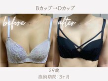 ハリスタ 六本木院(HARISTA)/3ヶ月間でBカップ→Dカップ
