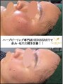 ハーバリー ハーブピーリング 岐阜(HERBERRYハーブピーリング)&nbsp;【剥離あり】リベルハーブピーリングは赤み・毛穴の開きにも◎
