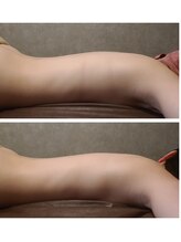 ウォーマル(warmaL)/ホットストーン+アロマタッチ