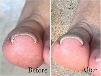 アンベリール(embellir.)/美爪クリエイターによる巻爪ケア