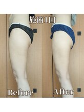 ヨサパーク サーナ 仙川(YOSA PARK Sana)/30代お客様ビフォー⇒アフター