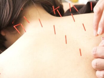 バランス鍼灸整骨院/整体 はり MIXの最強コース