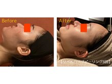 ロイヤリティ(ROYALTY)/ニキビ/お肌の凹凸/肌のごわつき