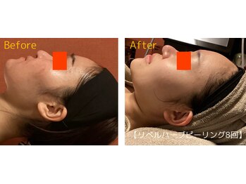 ロイヤリティ(ROYALTY)/ニキビ/お肌の凹凸/肌のごわつき