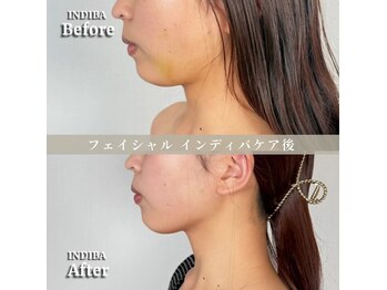術後の女神 大阪本町店/ダウンタイムケア・インディバ