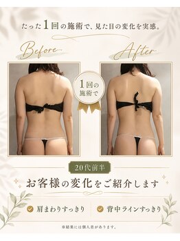 リンガ(Ringa)/1回で実感すっきり背中
