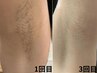脱毛が初めての方にも丁寧なご説明☆1部位しっかり10分コース5,500円→