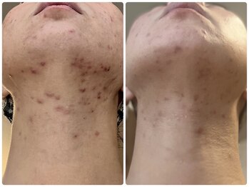 ククナ(KUKUna)/ハーブピーリングとスキンケア