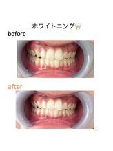 アレッド 大阪店(ared.)/大人気ホワイトニング