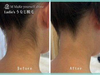 エム(M MaKe yourself shine)/うなじ脱毛|Before - After