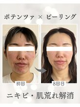 リノ ショウナン(LINO SHONAN)/ポテンツァ×ハーブピーリング