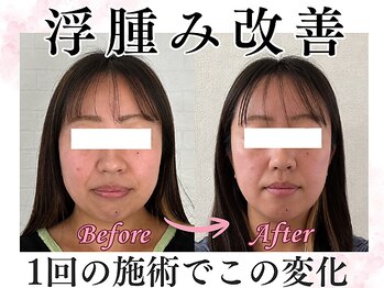 ジュピテール/小顔矯正 Before-After