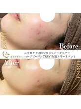 エスプリ 銀座店/ハーブピーリング銀座