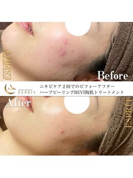 エスプリ 銀座店/ハーブピーリング銀座