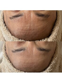 ウルス(ulus)/アンストレス＋ポレーション導入