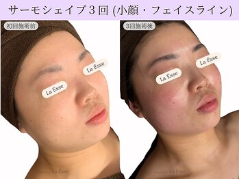 ラエッセ(La Esse)/小顔目指すサーモシェイプ