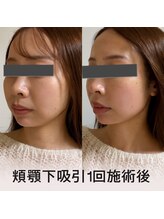 術後インディバ専門サロン 新宿/顎下吸引　施術後