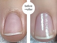 エマ(EMA)/貝爪でお悩みのお客様