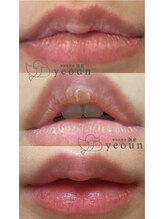 韓国肌管理yeoun【ヨウン】ROMAPINK/黒ずみ/毛穴/プラピール/ララピール福岡天神/ローマピンク福岡/メラニンケア