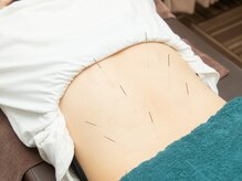 たんぽぽ整骨院鍼灸院/はり施術♪