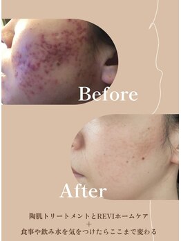 ファーストビューティー 千葉店(first beauty)/〈プラズマニア〉プラズマ