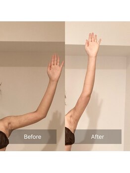 アラマンダ(Allamanda)/二の腕BeforeAfter