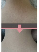 エルマナ(HERMANA)/うなじ脱毛・光脱毛・美肌・毛穴