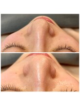 ロカヒ(Lokahi)/毛穴洗浄＋光フェイシャル