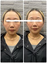 長寿鍼灸院 長寿整骨院/美容鍼50本の効果★小顔効果