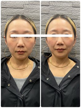 長寿鍼灸院 長寿整骨院/美容鍼50本の効果★小顔効果