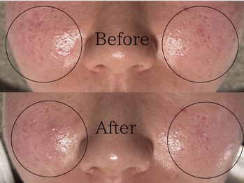 ルミライズ(lumirise)/〈２回目での効果〉