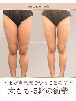 ベル(belle)の写真/【長年のお悩みから卒業】理想の美脚ラインへ☆「盛れる美脚」を叶えて、もっと自由にもっと楽しく♪