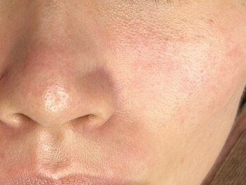 Uluの写真/【毛穴の黒ずみ・開きに】ハーブピーリング×黄土よもぎ蒸しのWケアで、毛穴レスな陶器肌を目指す☆