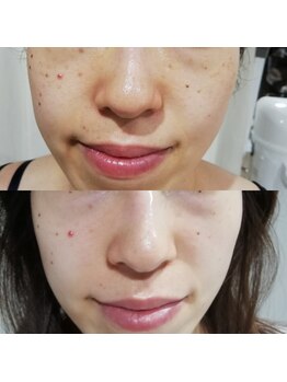 RiとBiのたまご/（フェイシャル）シミ改善