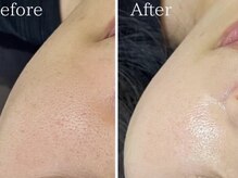 とぅるりん 肌質改善/【頬の毛穴ケアに！】