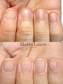 マリーロール 淀屋橋本店(Marie Laure)/自爪育成/深爪矯正/ネイルケア