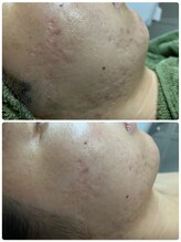 アレーズファイブフォー(A’LAISE54)/ニキビケアにお悩み２０代