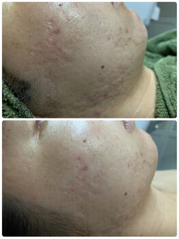 アレーズファイブフォー(A’LAISE54)/ニキビケアにお悩み２０代