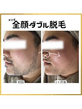 ジョエルワックス 沖縄コザ店(JOELLE WAX)/メンズ　髭ダブル脱毛☆