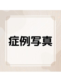 チェンジ 小山店(Change)/3回施術後の肌改善実感率99%!