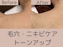 ベアール(beal)/背中ニキビケアのハーブ2回