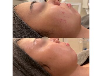 ラドンナ(LA DONNA)/ニキビ